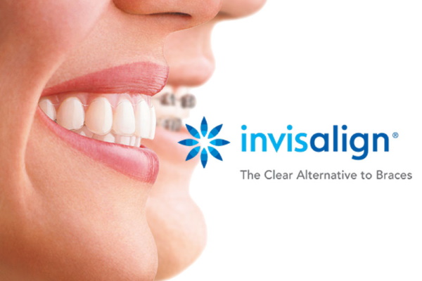 5ab28327554af9bb7cae0b1b_invisalign-the-clear-alternative-to-braces