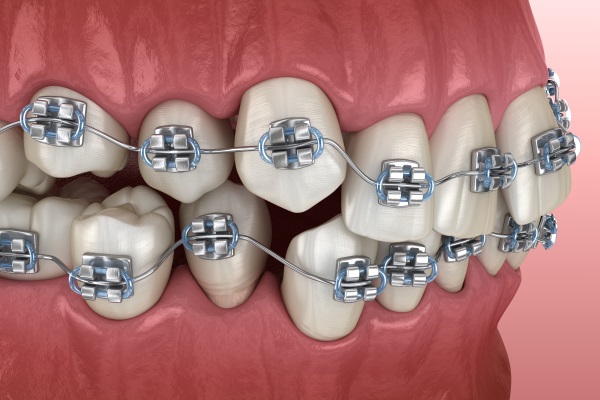 Abnormal teeth position and metal braces tretament. Medically accurate dental 3D illustration